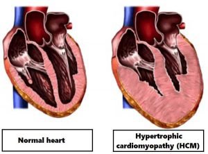 Hypertrophic Cardiomyopathy (HCM) in Cats, Symptoms and Treatment